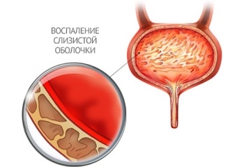 Воспаление слизистой оболочки