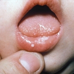 Воспаление на губе