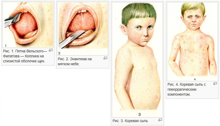 Симптомы кори у ребенка 1 год thumbnail